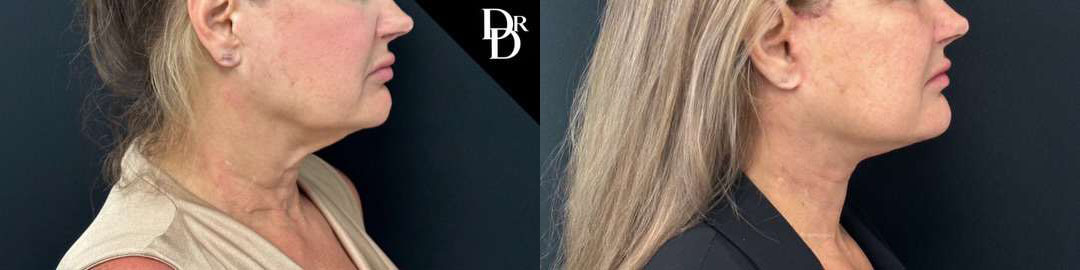 Facelift Before And After Photos By Dr. Demetri Arnaoutakis In Tampa, Fl