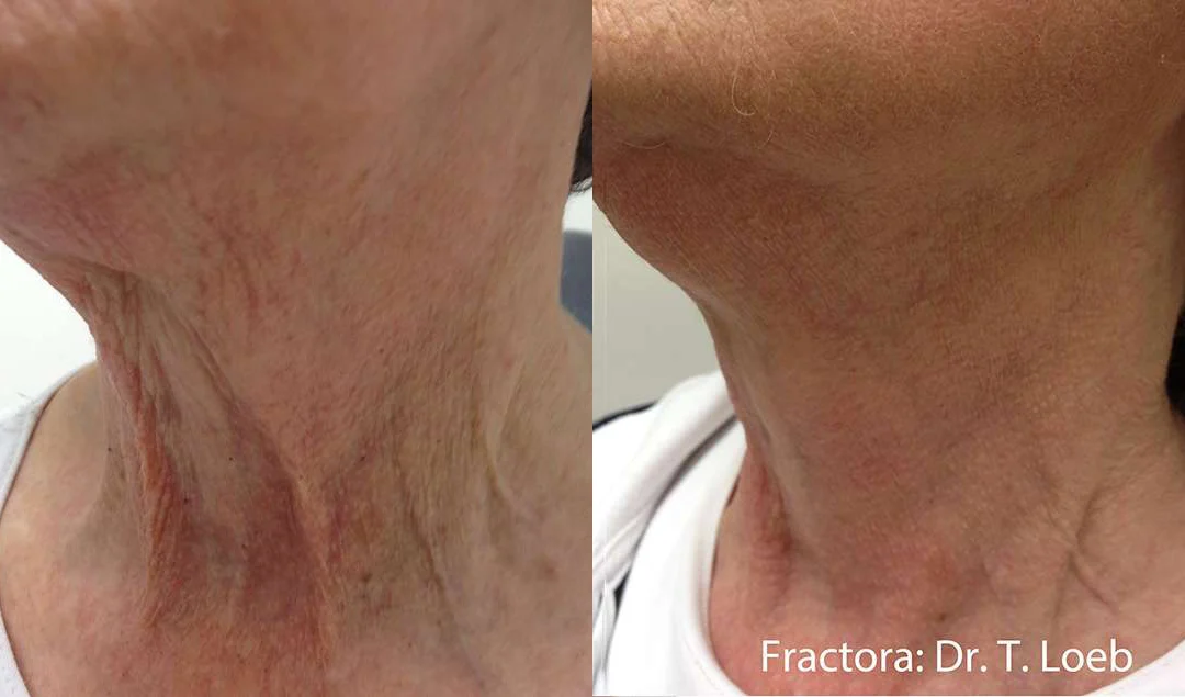 Facetite Before And After Photos By Dr. Demetri Arnaoutakis In Tampa, Fl
