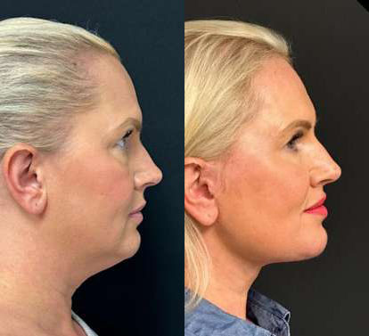 Facelift Before And After Photos By Dr. Demetri Arnaoutakis In Tampa, Fl