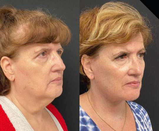 Neck Lift before and after photos by Dr. Demetri Arnaoutakis in Tampa, FL