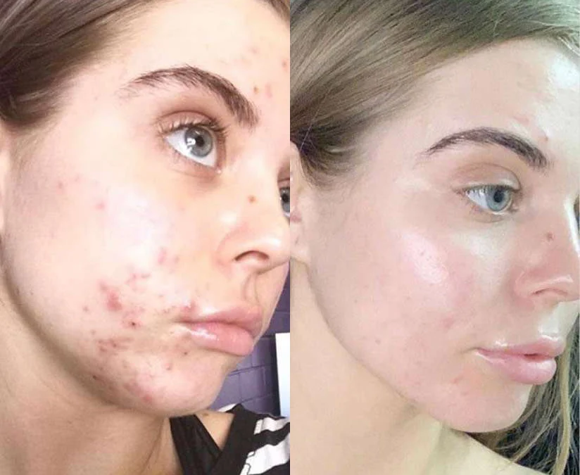 Chemical Peels Before And After Photos By Dr. Demetri Arnaoutakis In Tampa, Fl