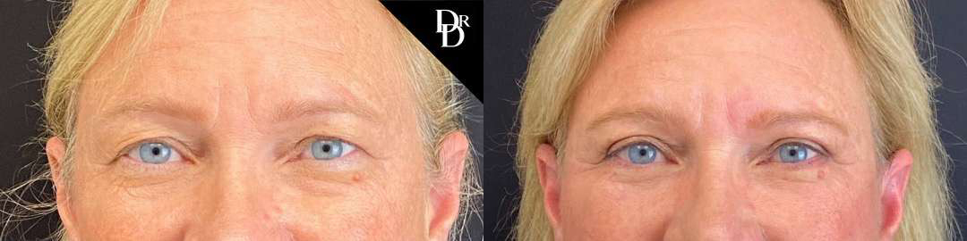 Eyelid Surgery before and after photos by Dr. Demetri Arnaoutakis in Tampa, FL