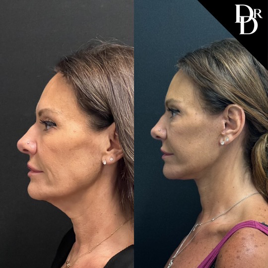 Facelift Before And After Photos By Dr. Demetri Arnaoutakis In Tampa, Fl