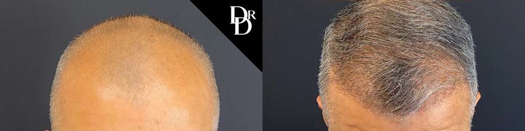 Hair Transplant Before And After Photos By Dr. Demetri Arnaoutakis In Tampa, Fl