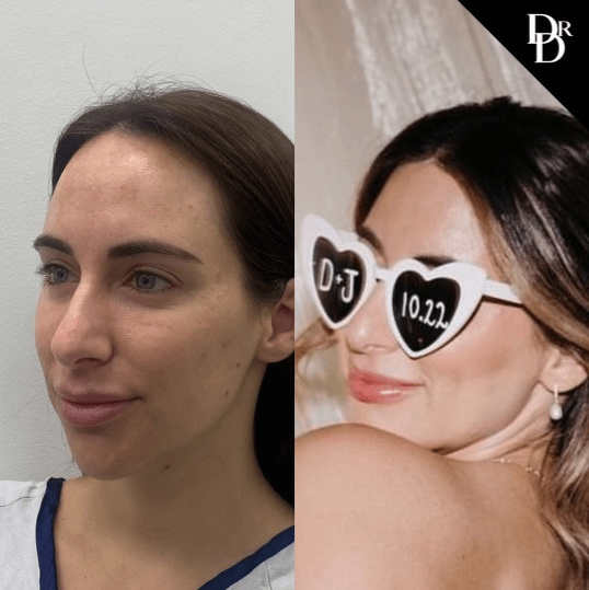 Hairline Lowering Surgery Before And After Photos By Dr. Demetri Arnaoutakis In Tampa, Fl