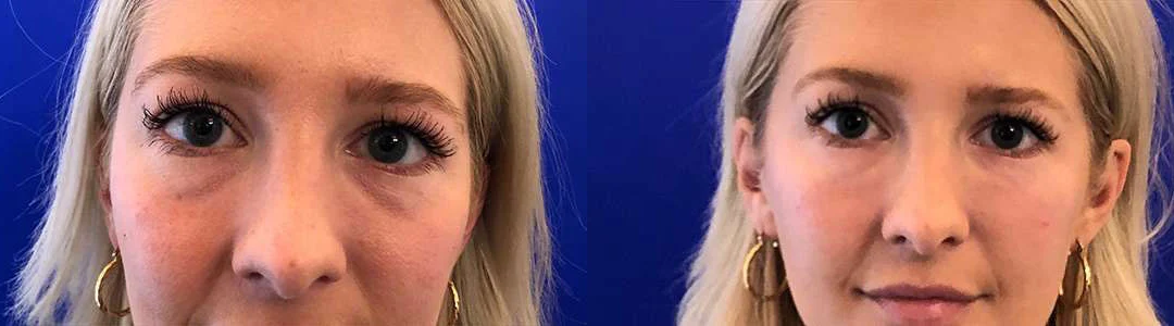 Injectable/Dermal Fillers Before And After Photos By Dr. Demetri Arnaoutakis In Tampa, Fl
