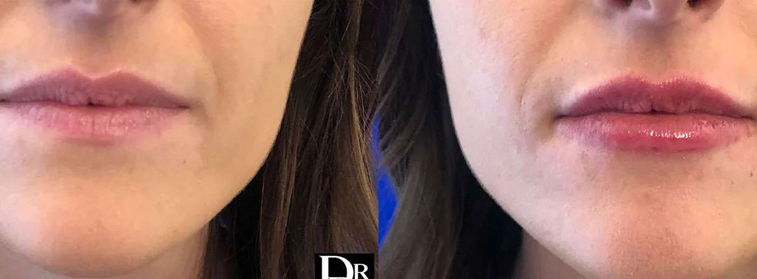 Injectable/Dermal Fillers Before And After Photos By Dr. Demetri Arnaoutakis In Tampa, Fl