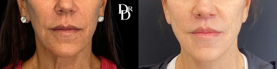 Lip Lift before and after photos by Dr. Demetri Arnaoutakis in Tampa, FL