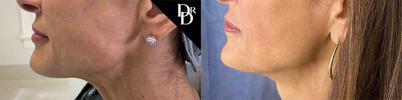 Morpheus8 Before And After Photos By Dr. Demetri Arnaoutakis In Tampa, Fl