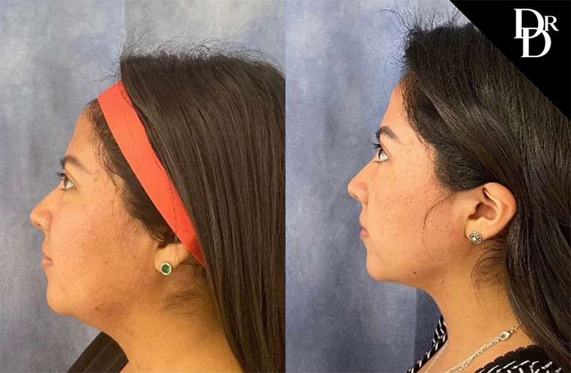 Neck Lift Before And After Photos By Dr. Demetri Arnaoutakis In Tampa, Fl
