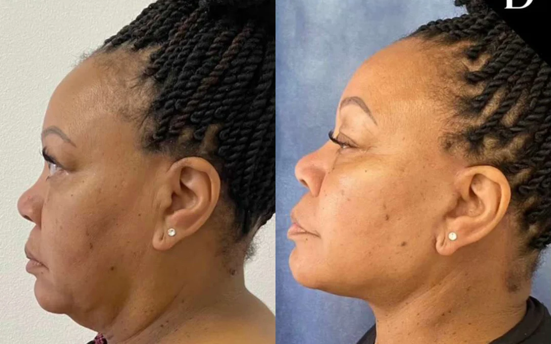 Facelift Before And After Photos By Dr. Demetri Arnaoutakis In Tampa, Fl