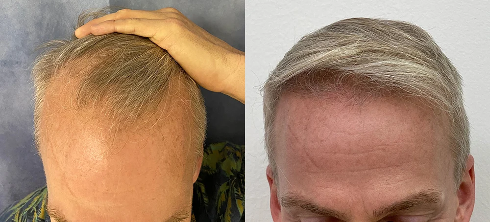 Hair Transplant Before And After Photos By Dr Demetri Arnaoutakis In Tampa Fl
