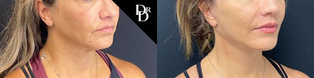 Neck Lift before and after photos by Dr. Demetri Arnaoutakis in Tampa, FL