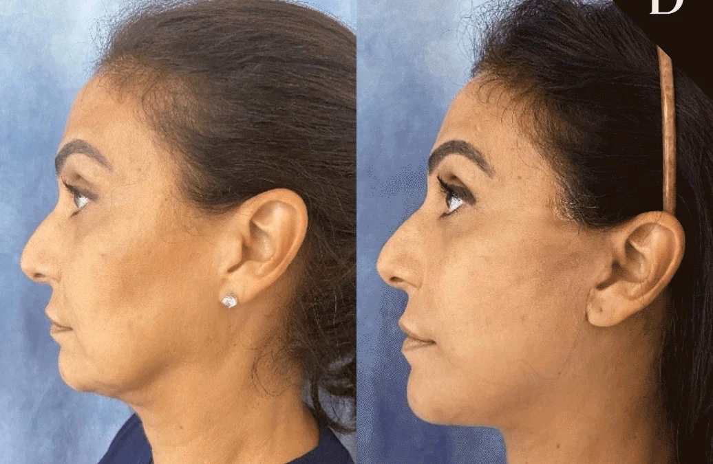 Facelift Before And After Photos By Dr. Demetri Arnaoutakis In Tampa, Fl