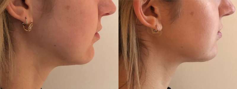 Buccal Fat Pad Removal before and after photos by Dr. Demetri Arnaoutakis in Tampa, FL