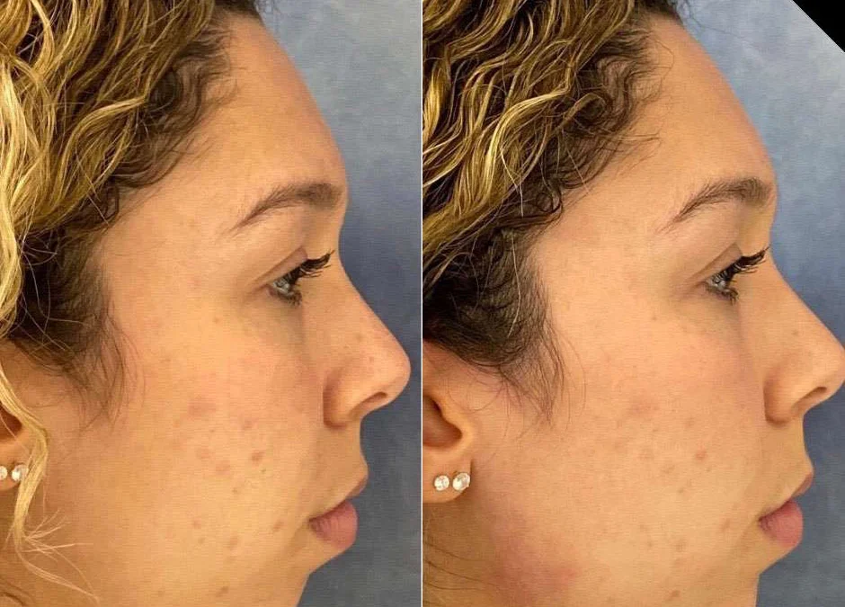 Chin Augmentation before and after photos by Dr. Demetri Arnaoutakis in Tampa, FL