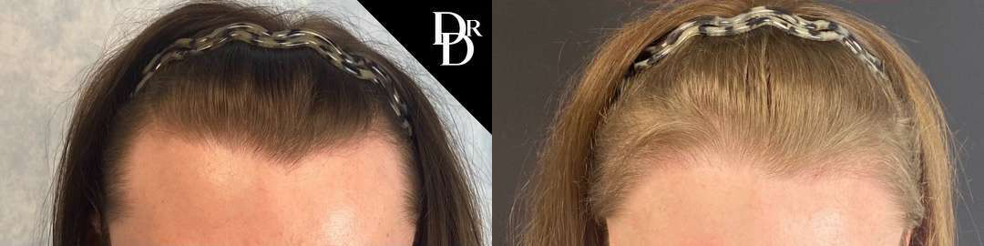 Hair Transplant Before And After Photos By Dr. Demetri Arnaoutakis In Tampa, Fl