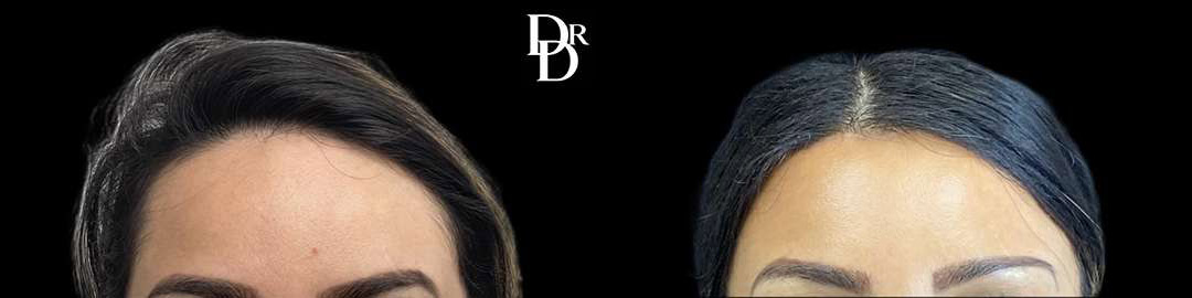 Hairline Lowering Surgery Before And After Photos By Dr. Demetri Arnaoutakis In Tampa, Fl