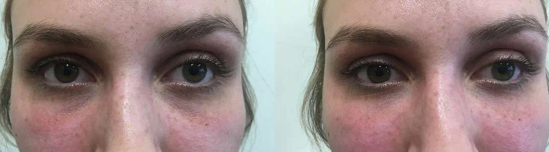Injectable/Dermal Fillers Before And After Photos By Dr. Demetri Arnaoutakis In Tampa, Fl