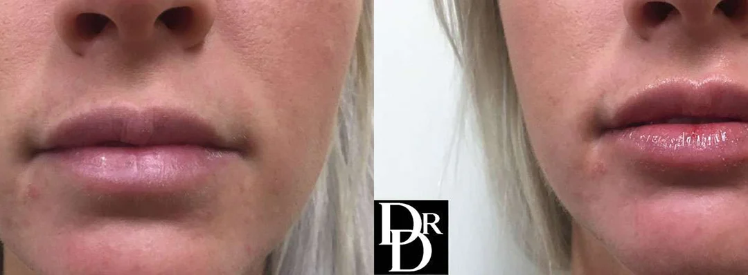 Injectable/Dermal Fillers Before And After Photos By Dr. Demetri Arnaoutakis In Tampa, Fl