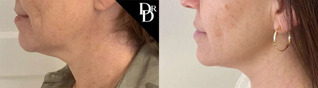 Morpheus8 Before And After Photos By Dr. Demetri Arnaoutakis In Tampa, Fl