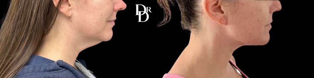 Neck Lift before and after photos by Dr. Demetri Arnaoutakis in Tampa, FL