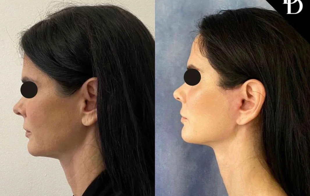 Facelift Before And After Photos By Dr. Demetri Arnaoutakis In Tampa, Fl