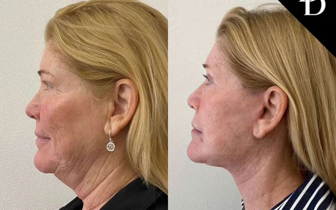 Neck Lift before and after photos by Dr. Demetri Arnaoutakis in Tampa, FL