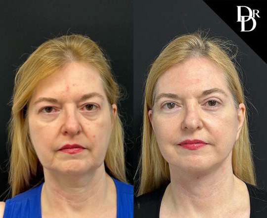 Facelift Before And After Photos By Dr. Demetri Arnaoutakis In Tampa, Fl