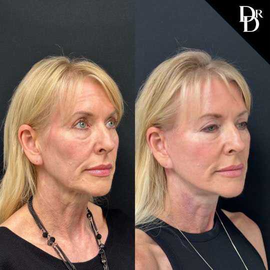 Facelift Before And After Photos By Dr. Demetri Arnaoutakis In Tampa, Fl