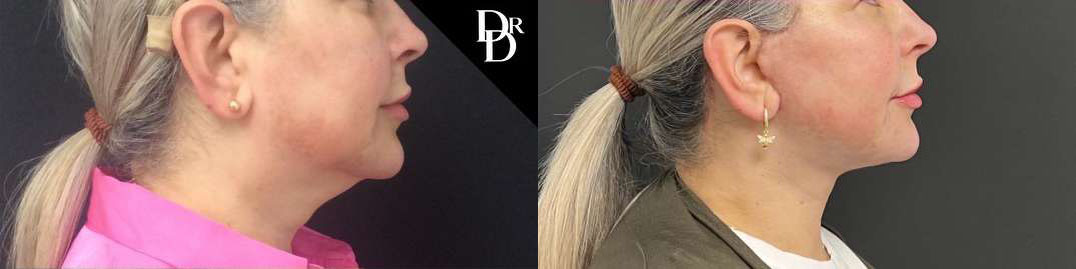 Facelift Before And After Photos By Dr. Demetri Arnaoutakis In Tampa, Fl