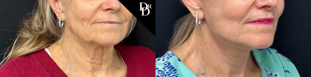 Facelift Before And After Photos By Dr. Demetri Arnaoutakis In Tampa, Fl