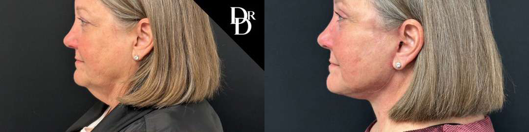 Facelift Before And After Photos By Dr. Demetri Arnaoutakis In Tampa, Fl