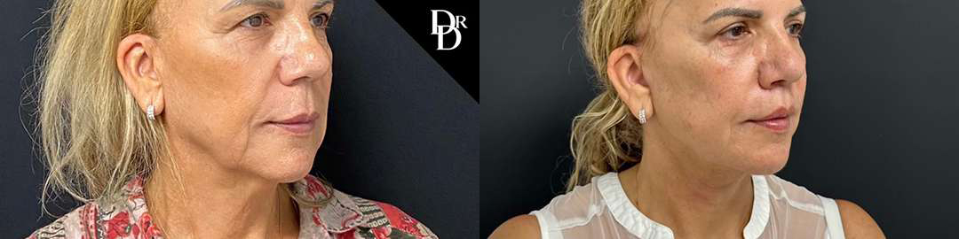 Facelift Before And After Photos By Dr. Demetri Arnaoutakis In Tampa, Fl