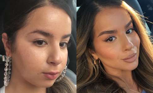 Buccal Fat Pad Removal before and after photos by Dr. Demetri Arnaoutakis in Tampa, FL