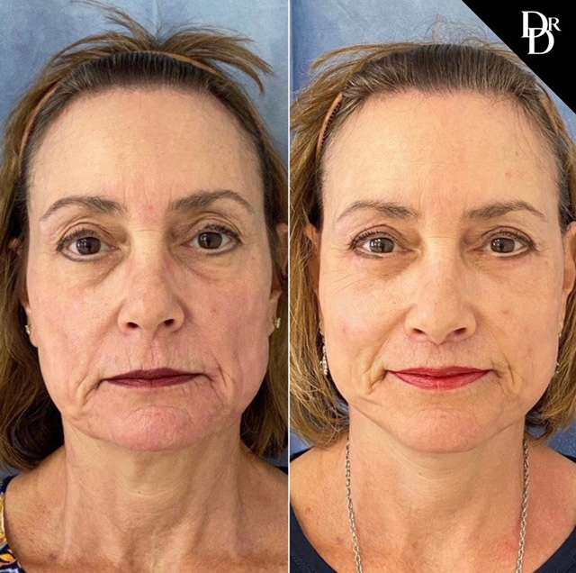 Eyelid Surgery Before And After Photos By Dr. Demetri Arnaoutakis In Tampa, Fl