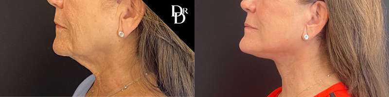 Facelift Before And After Photos By Dr. Demetri Arnaoutakis In Tampa, Fl