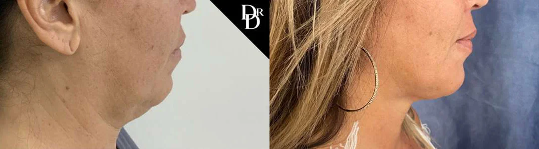 Facetite Before And After Photos By Dr. Demetri Arnaoutakis In Tampa, Fl
