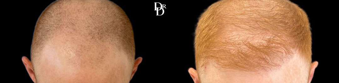 Hair Transplant Before And After Photos By Dr. Demetri Arnaoutakis In Tampa, Fl