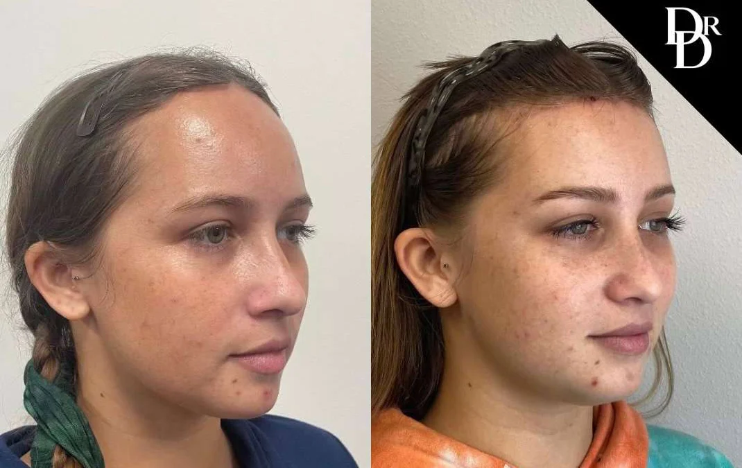 Hairline Lowering Surgery Before And After Photos By Dr. Demetri Arnaoutakis In Tampa, Fl