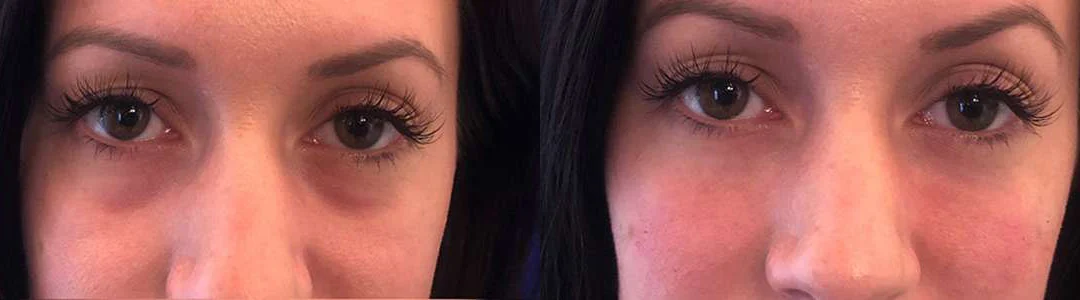 Injectable/Dermal Fillers Before And After Photos By Dr. Demetri Arnaoutakis In Tampa, Fl