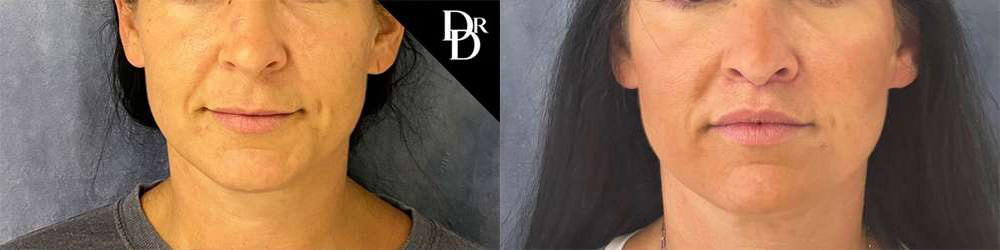Lip Lift before and after photos by Dr. Demetri Arnaoutakis in Tampa, FL