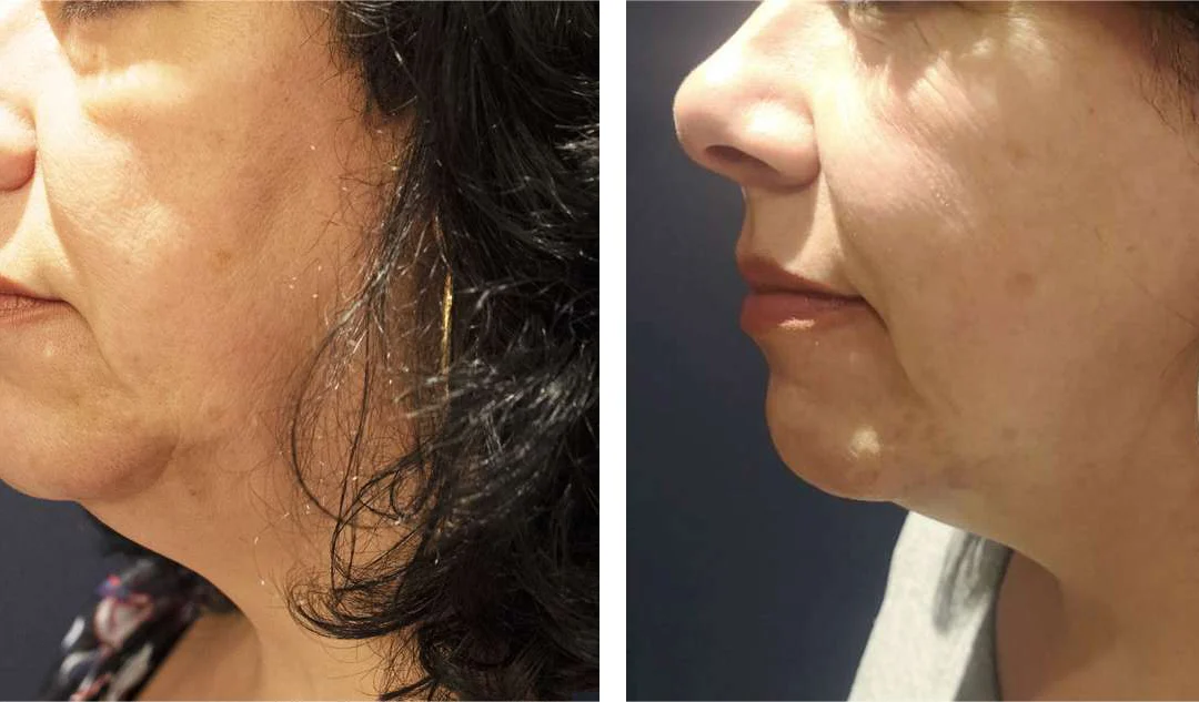 Morpheus8 Before And After Photos By Dr. Demetri Arnaoutakis In Tampa, Fl