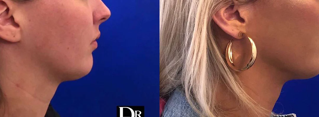 Neck Lift Before And After Photos By Dr. Demetri Arnaoutakis In Tampa, Fl