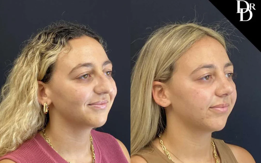 Rhinoplasty before and after photos by Dr. Demetri Arnaoutakis in Tampa, FL