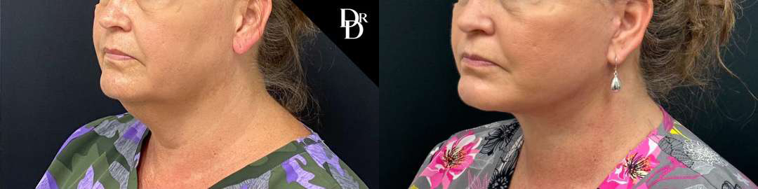 Facelift Before And After Photos By Dr. Demetri Arnaoutakis In Tampa, Fl