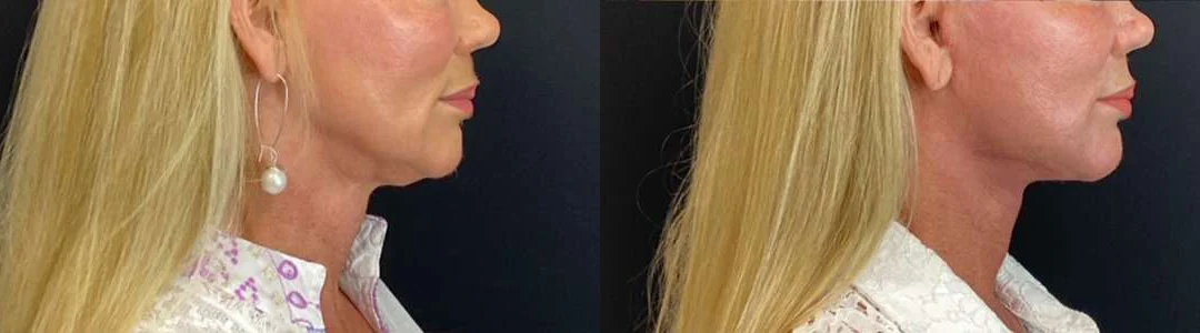 Facelift Before And After Photos By Dr. Demetri Arnaoutakis In Tampa, Fl