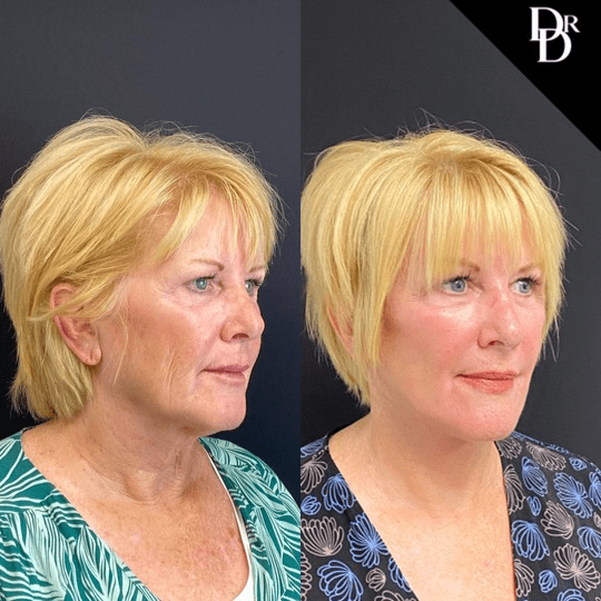Facelift Before And After Photos By Dr. Demetri Arnaoutakis In Tampa, Fl