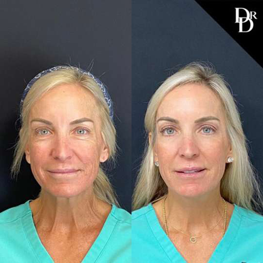 Facelift Before And After Photos By Dr. Demetri Arnaoutakis In Tampa, Fl