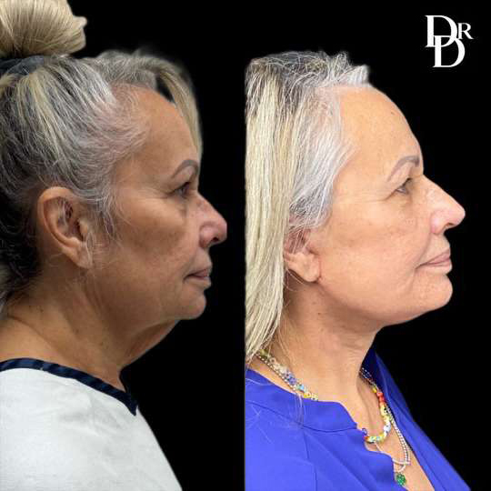 Facelift Before And After Photos By Dr. Demetri Arnaoutakis In Tampa, Fl